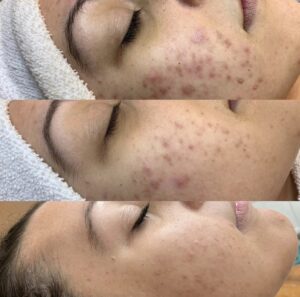 A woman with acne on her face and the same person is showing them different stages of their skin.