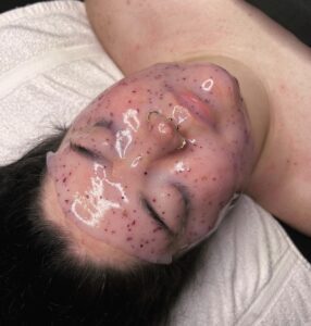 A person with white spots on their face and neck.